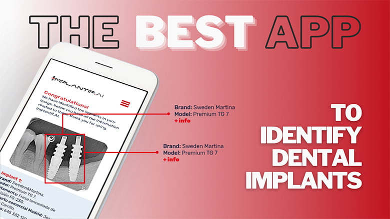 10 reasons why Implantifai is the best app for Implant Identification