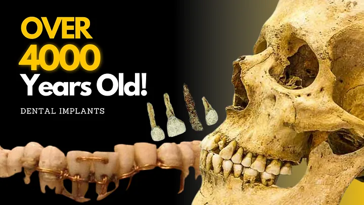 From Bamboo Pegs to AI: A Fascinating Journey Through the History of Dental Implants