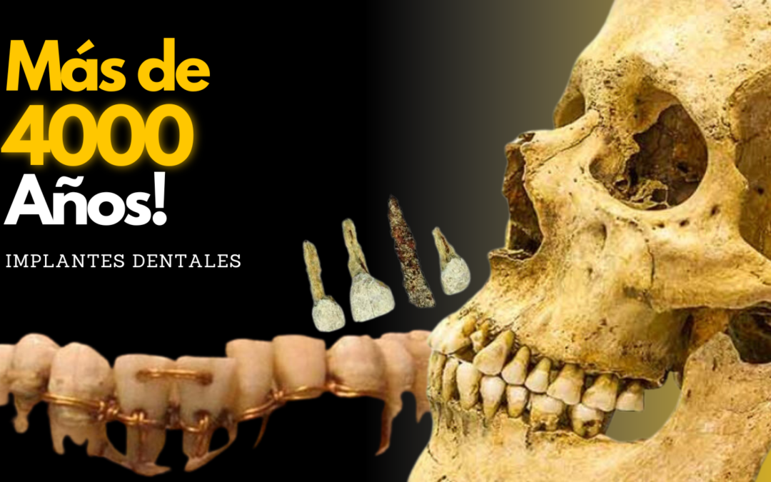 Desde clavijas de bambú hasta la IA: Un fascinante viaje a través de la historia de los implantes dentales